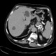 Abscess in liver, cholangoitis, maturation, first CT: CT - Computed tomography